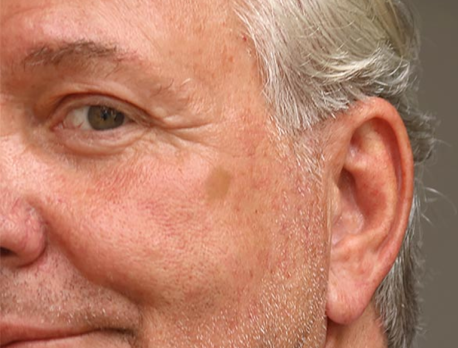 lentigo-treatment-before-after-1200X600 1 (2)